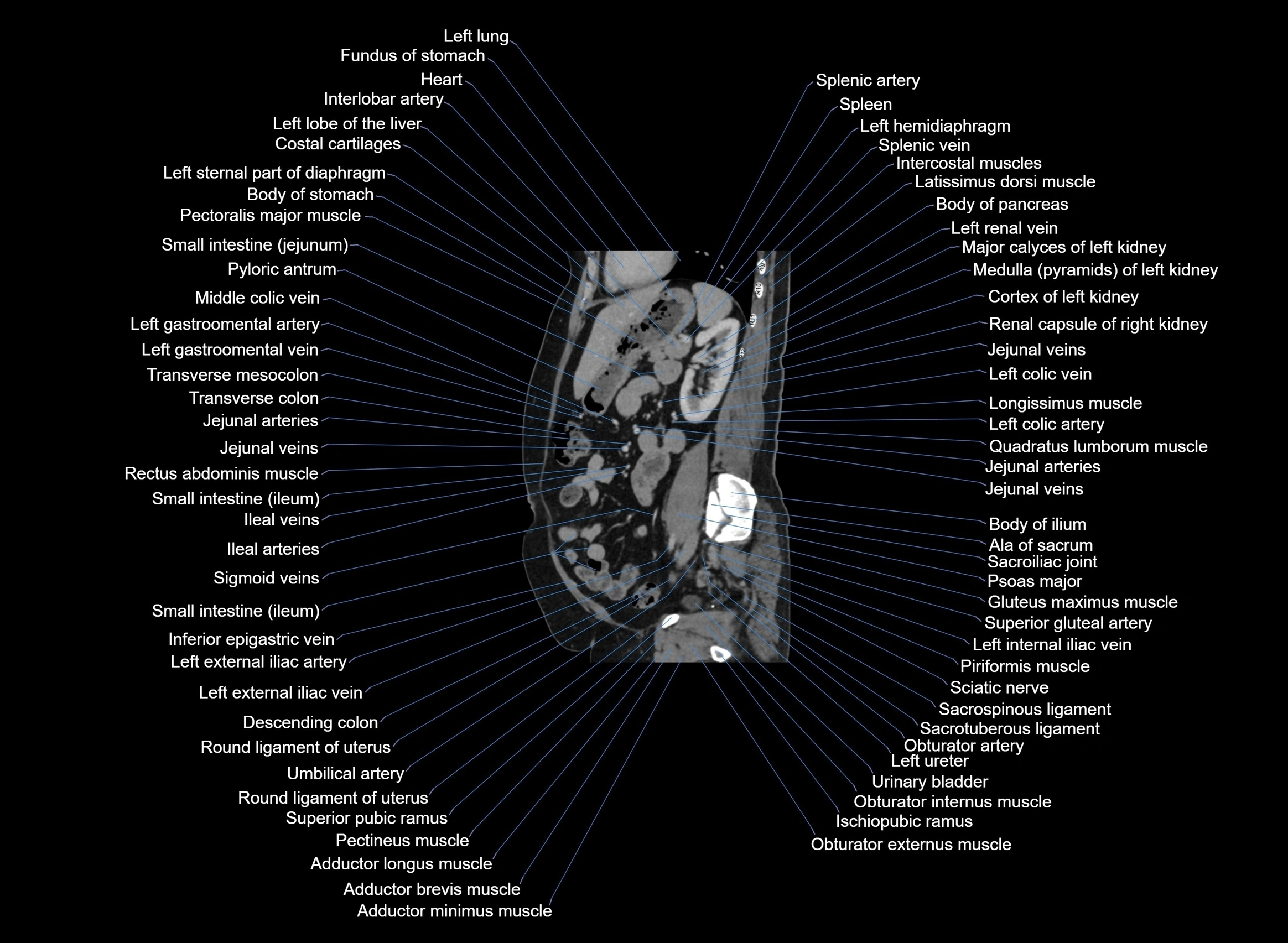 CT Abdomen sagittal cross sectional anatomy labelled radiology image -00042.webp